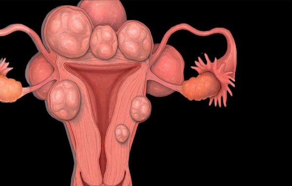 میوم یا فیبروم رحمی چیست؟